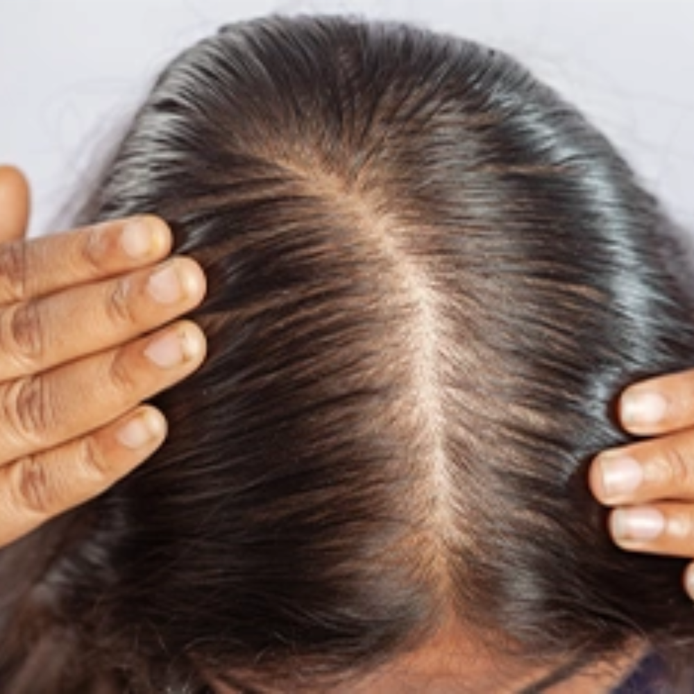 Hairfall Treatment (Female)