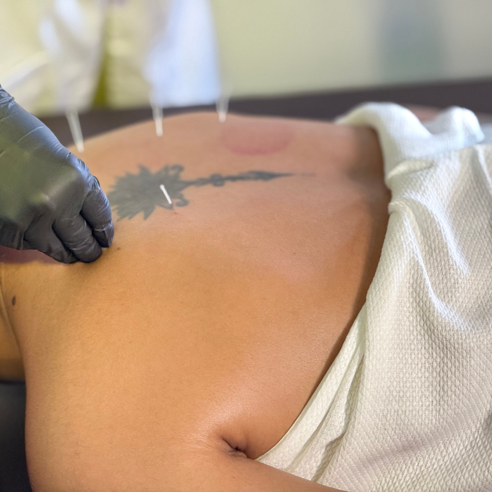 Acupuncture without Stimulation