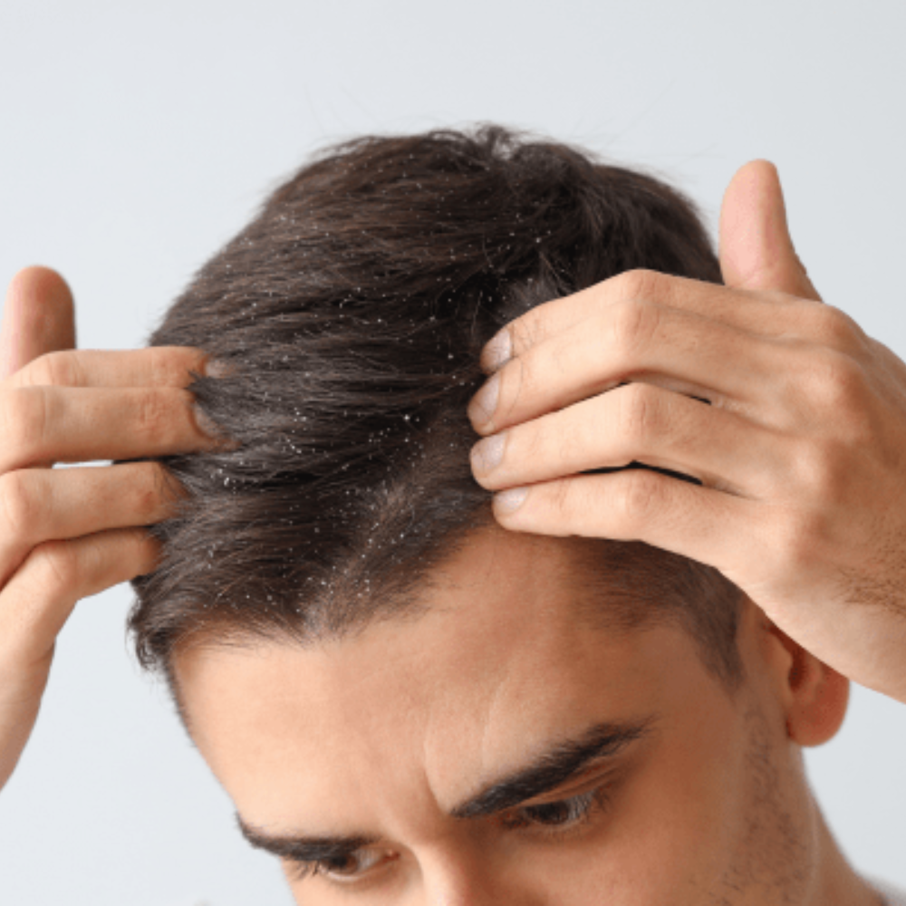 Dandruff Treatment (Male)